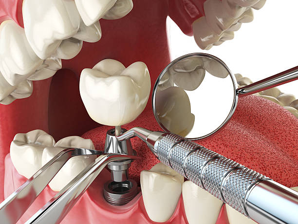 Best Emergency Root Canal Therapy in Ransomville, NY